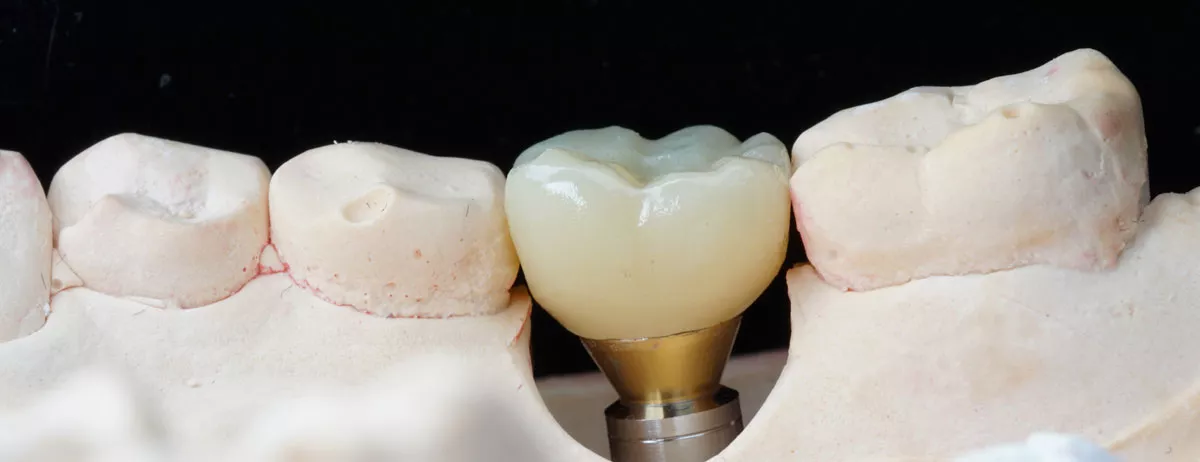 Abutment Nedir?