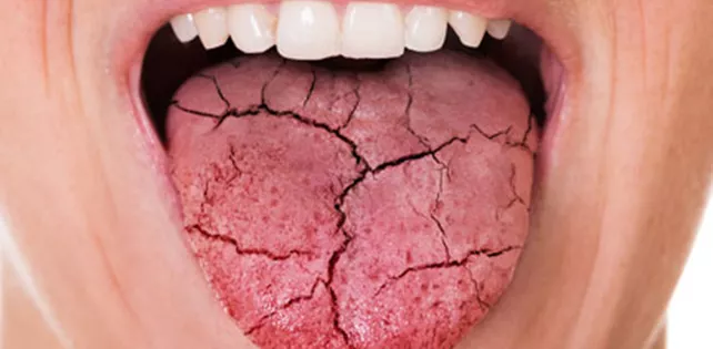 Ağız Kuruluğu Nedir?