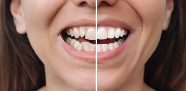 Çarpık Diş Tedavisi Nasıl Uygulanır?