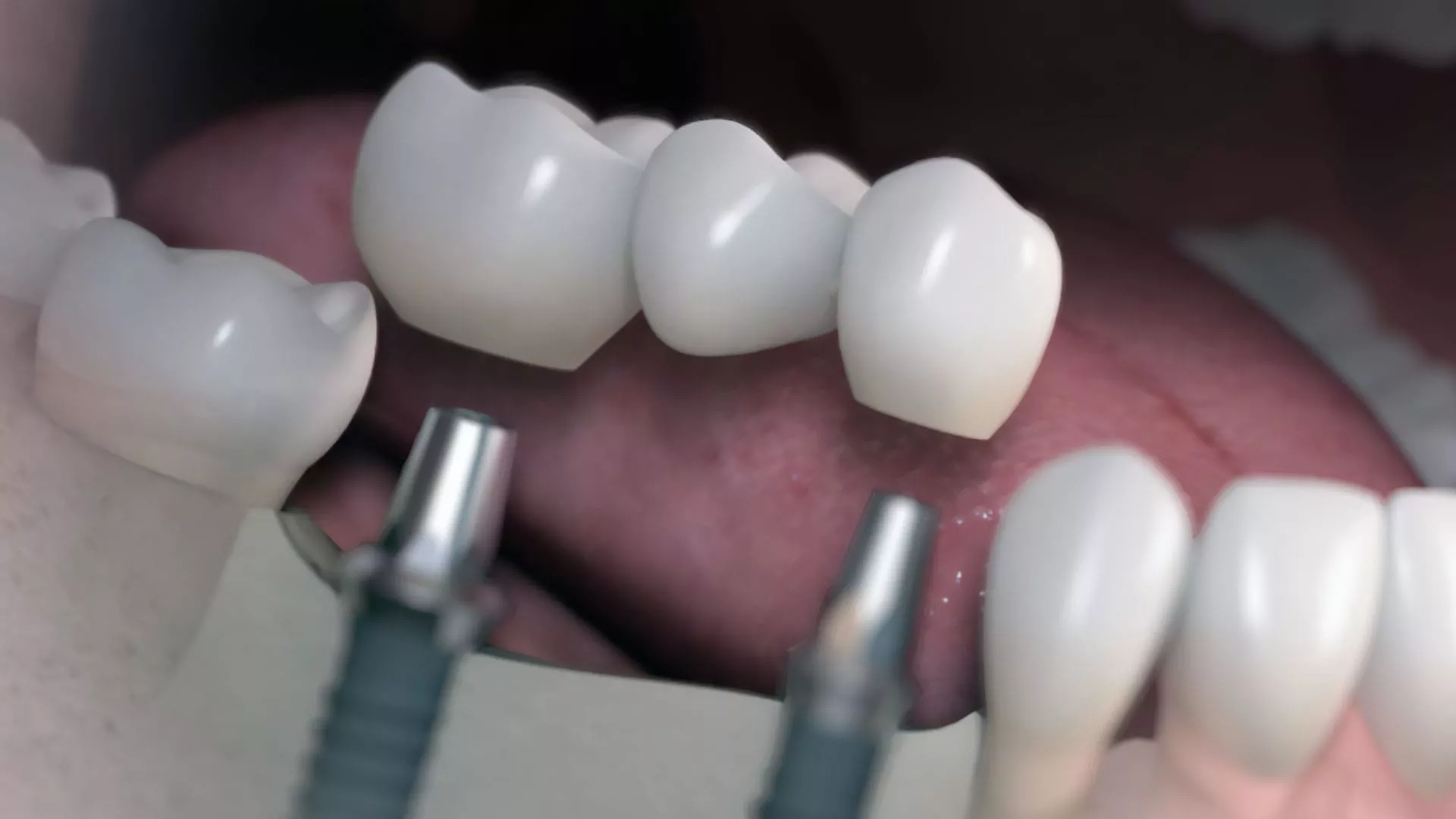 Çoklu Diş İmplantı Hizmeti