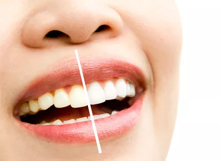 Diş Beyazlatma Dişe Zarar Verir Mi?