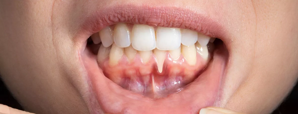 Diş Eti Çekilmesi (Periodontitis) Nedir?
