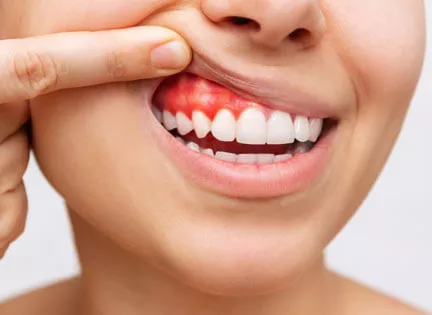 Diş Eti Estetiği (Gummy Smile Botoks) Nedir? Nasıl Yapılır?