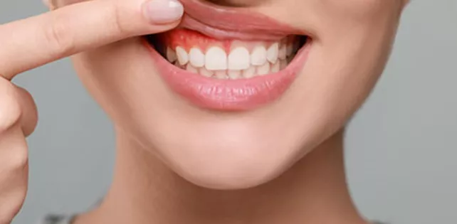 Diş Eti İltihabı Nedir?