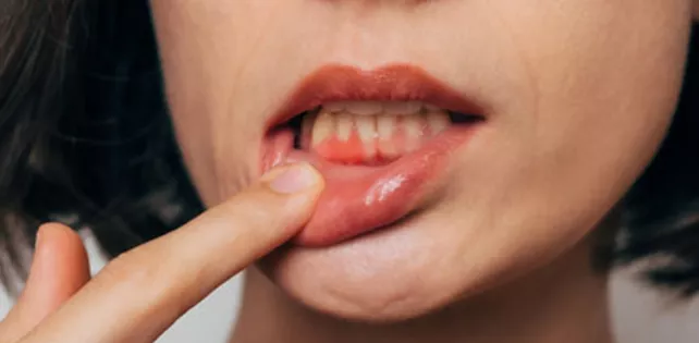 Diş Eti Kaşıntısı Nedir?