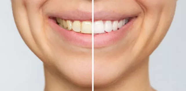 Diş Minesi Nasıl Güçlendirilir?