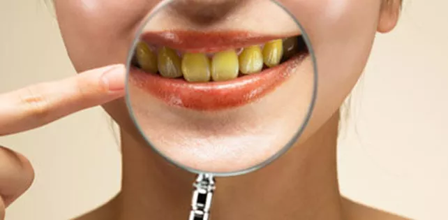 Diş Sararması Neden Olur? Nasıl Geçer?