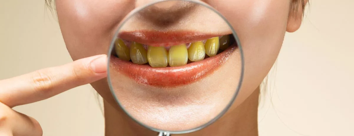 Diş Sararması Neden Olur? Nasıl Geçer?