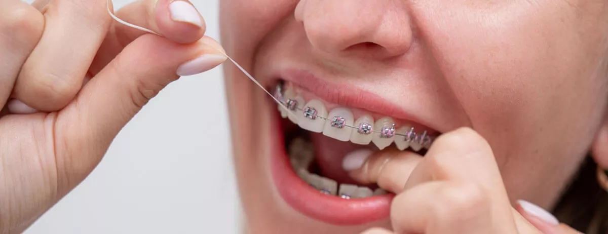 Diş Teli Tedavisi Nedir?