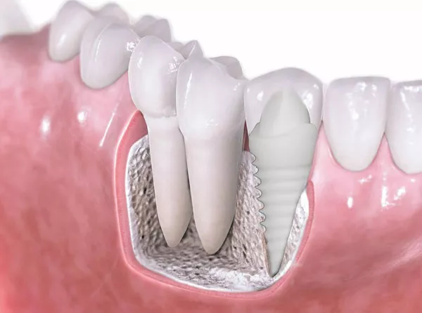 İmplant Üstü Zirkonyum Kaplama