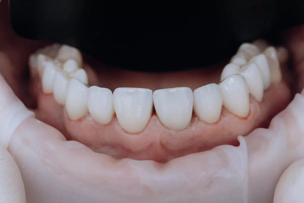 Metal Destekli Kaplamaların Zirkonyum ile Değişimi