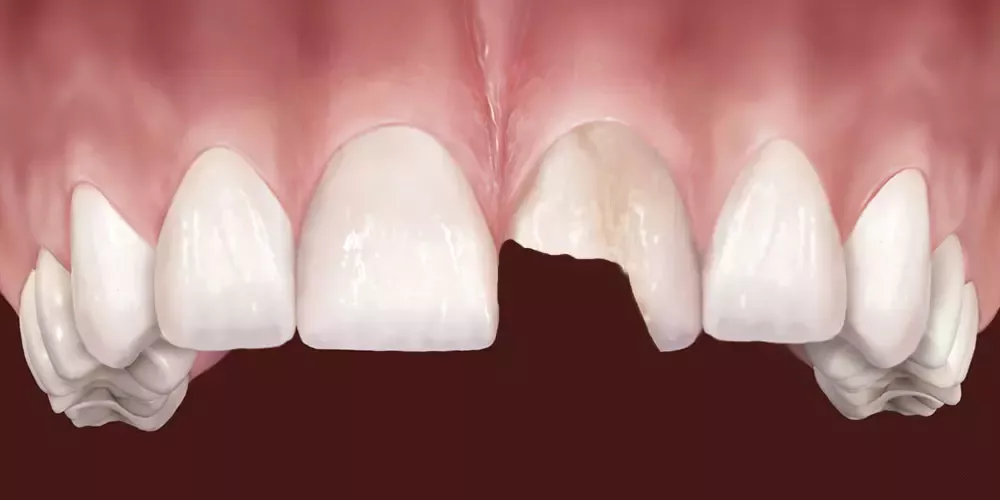 Kırık veya Aşınmış Dişlerin Onarımı